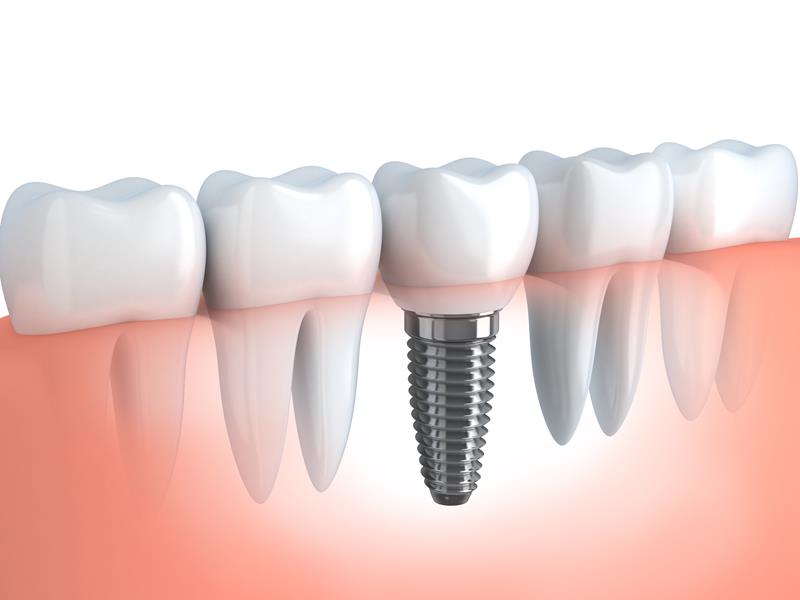 Dental Implants  Socorro, TX 