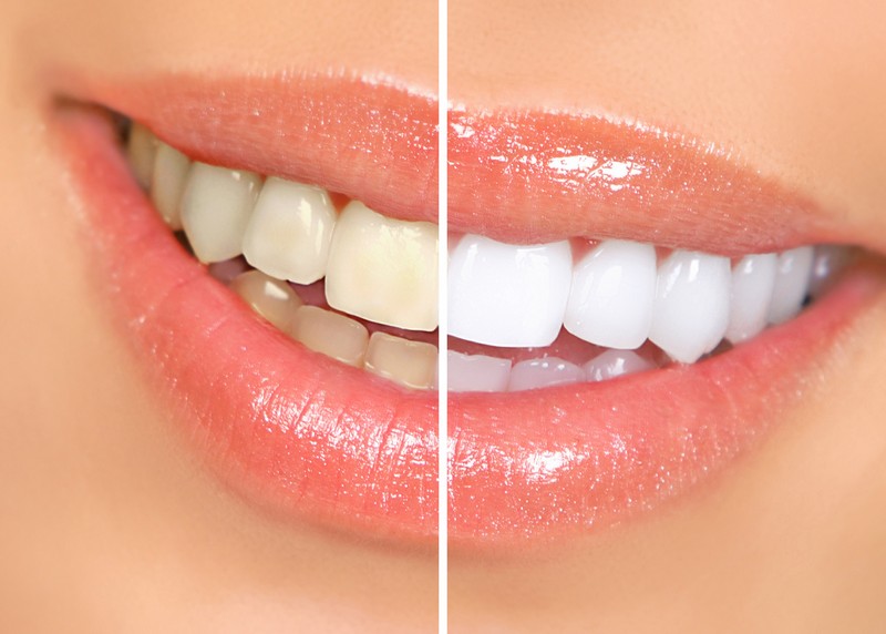 Teeth Whitening  Socorro, TX 